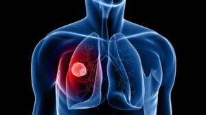 How Lung Cancer Treatment Improves Quality of Life